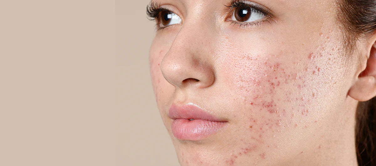 The Best Over-the-Counter Blemishes Treatment Products, According to Dermatologist